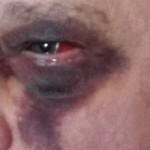 5 Days After Surgery